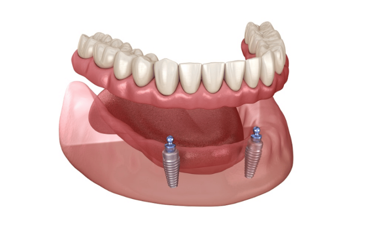 Mini Dental Implants: Smaller Solutions, Big Benefits in Dexter